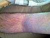 Dangling Right Arm Post ACDF Surgery-2014-01-30-16-55-46-jpg