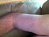 Dangling Right Arm Post ACDF Surgery-2014-01-30-16-56-48-jpg