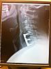 Dangling Right Arm Post ACDF Surgery-2014-01-30-11-04-09-jpg