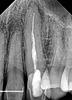 Can't decide what to do with my root canal-chriscroot-jpg