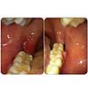 Wisdom teeth extraction woes..-image-jpg