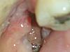 Post Wisdom teeth extraction Query-20150202_110552-jpg