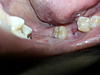 Infection after tooth extraction?-20150323_214017-1-jpg