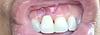 Bone Graft for Front Tooth-img_7072-jpg