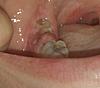 Infection after extraction 3 weeks ago-20150506_194952-1-1-jpg