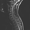 Possible TOS, how to get a diagnosis-cervical-view-jpg