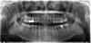 Infected root canal tooth for years? Neurological symptoms possible?-martin-haung-2-jpg