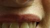 Horizontal crease above upper lip following oral surgery-lip-jpg
