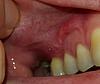 Horizontal crease above upper lip following oral surgery-2015-08-03-23-31-33-jpg