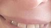 Horizontal crease above upper lip following oral surgery-2015-08-04-17-37-37-jpg