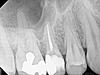 Is there anything wrong with my upper tooth?-post-root-canal-xray-jpg