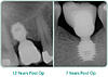 Mini implant &amp; pieces extraction-bicon-implant-xray-jpg
