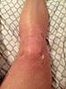 RFA of knee, anyone had one?-image-jpg