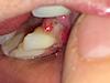 Gum inflammation after extraction/bone graft-img_0853-jpg