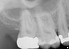 Periapical x-rays (retained roots and infection?) Bryanna can you please take a look?-pa-2-4-jpg