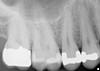 Periapical x-rays (retained roots and infection?) Bryanna can you please take a look?-pa-2-5-jpg