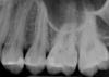 Periapical x-rays (retained roots and infection?) Bryanna can you please take a look?-pa-12-15-jpg
