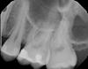 Periapical x-rays (retained roots and infection?) Bryanna can you please take a look?-x11770_1-jpg