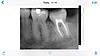 Wisdom tooth question for Bryanna! Please help-image-jpg