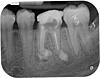 Bony Bump under an extracted tooth-2538-20160111-095556-xgwvq3nbpgmf-3-jpg
