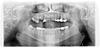 Bony Bump under an extracted tooth-2538-20160215-184052-xkjc-fhit9gt-3-jpg