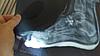 Anyone had foot arthrodesis (fusion)?-uploadfromtaptalk1456806428914-jpg