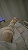 Anyone had foot arthrodesis (fusion)?-uploadfromtaptalk1456806516472-jpg