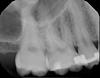 Upper First Molars (X-rays) Bryanna can you please take a look?-x11770_2-jpg