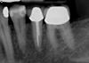 Possible cracked tooth #21 can you please take a look Bryanna?-26_pa-19-21-jpg