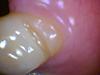 Possible cracked tooth #21 can you please take a look Bryanna?-016-06-12-210111-jpg