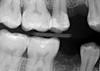 Gum Pain around one tooth - filling faulty?-15_rt-molar-bw-1-jpg