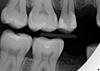 Gum Pain around one tooth - filling faulty?-14_rt-premolar-bw-jpg