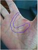 Index/Long finger pain, &amp; Palm/Wrist-hand-17-oct-2016-scar-jpg