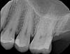 Tooth #14 concerns, Bryanna can you take a look?-14b-jpg