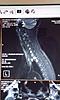 MRI Impressions please - reverse cervical curve, thoracic perineural-imag6714-jpg