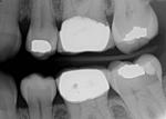 Possible RCT or Implant for #18 xray attached-tooth-18-jpg