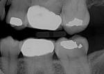Possible RCT or Implant for #18 xray attached-oct-tooth-18-jpg