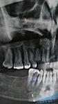Can My Dental Cysts Be Non-Surgically Removed ?-goslhwh-1-jpg