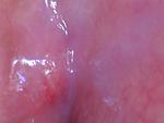 #5 Retained root and infection?-5-bump-swelling-jaw-jpg