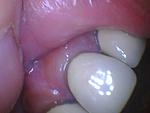 #7 Apicoectomy and Teeth Extraction-dig-8-9b-pre-jpg