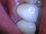#7 Apicoectomy and Teeth Extraction-dig-9-10-pre-jpg