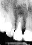 #7 Apicoectomy and Teeth Extraction-pa-6-thru-8-pre-jpg