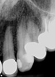 #7 Apicoectomy and Teeth Extraction-pa-10-thru-13-pre-jpg