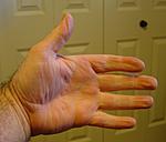 Newly diagnosed with PN - odd change in finger pads-fingers01-jpg