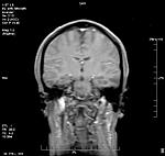 Does This Look Like A Normal (Negative) MRI Result?-klemp-brain-scan-jpg